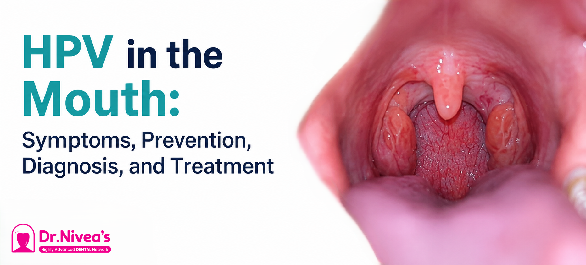 hpv-in-the-mouth-symptoms-prevention-diagnosis-and-treatment